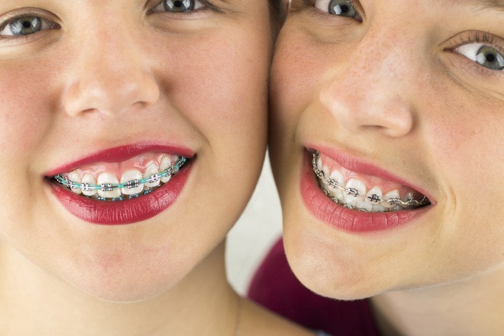 Will Wisdom Tooth Extraction Be Necessary Before You Get Braces?