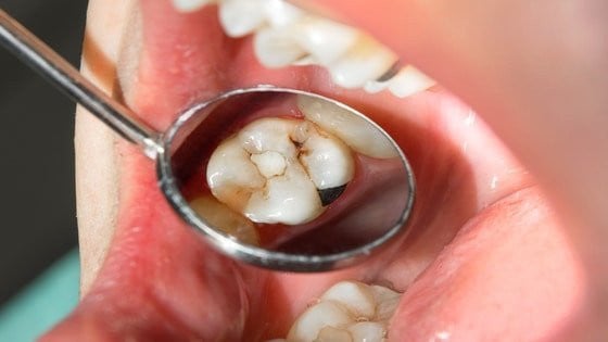 Can One Rotten Tooth Affect Others? Exploring the Connection Between Dental  Health and Overall Wellness